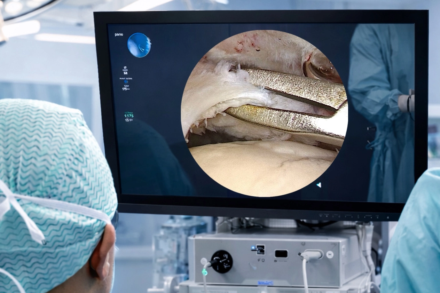 arthroscopic rotator cuff tear repair visualization during shoulder surgery in Dubai