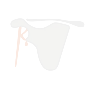 Severe shoulder arthritis illustration showing joint degeneration
