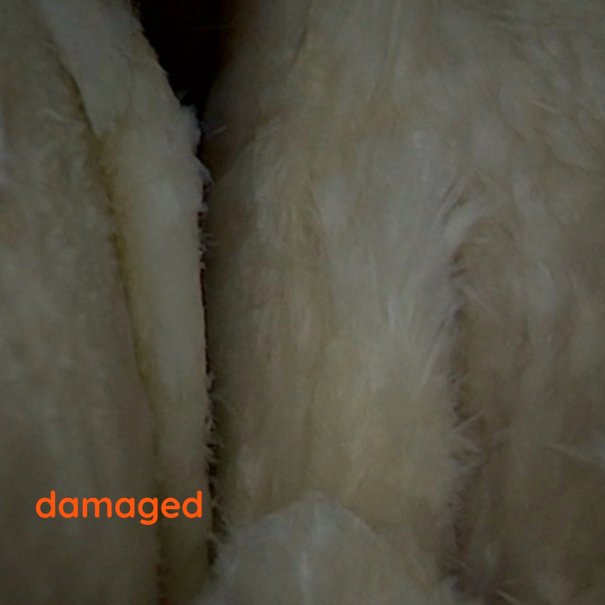 severe shoulder cartilage damage due to arthritis arthroscopy Dubai