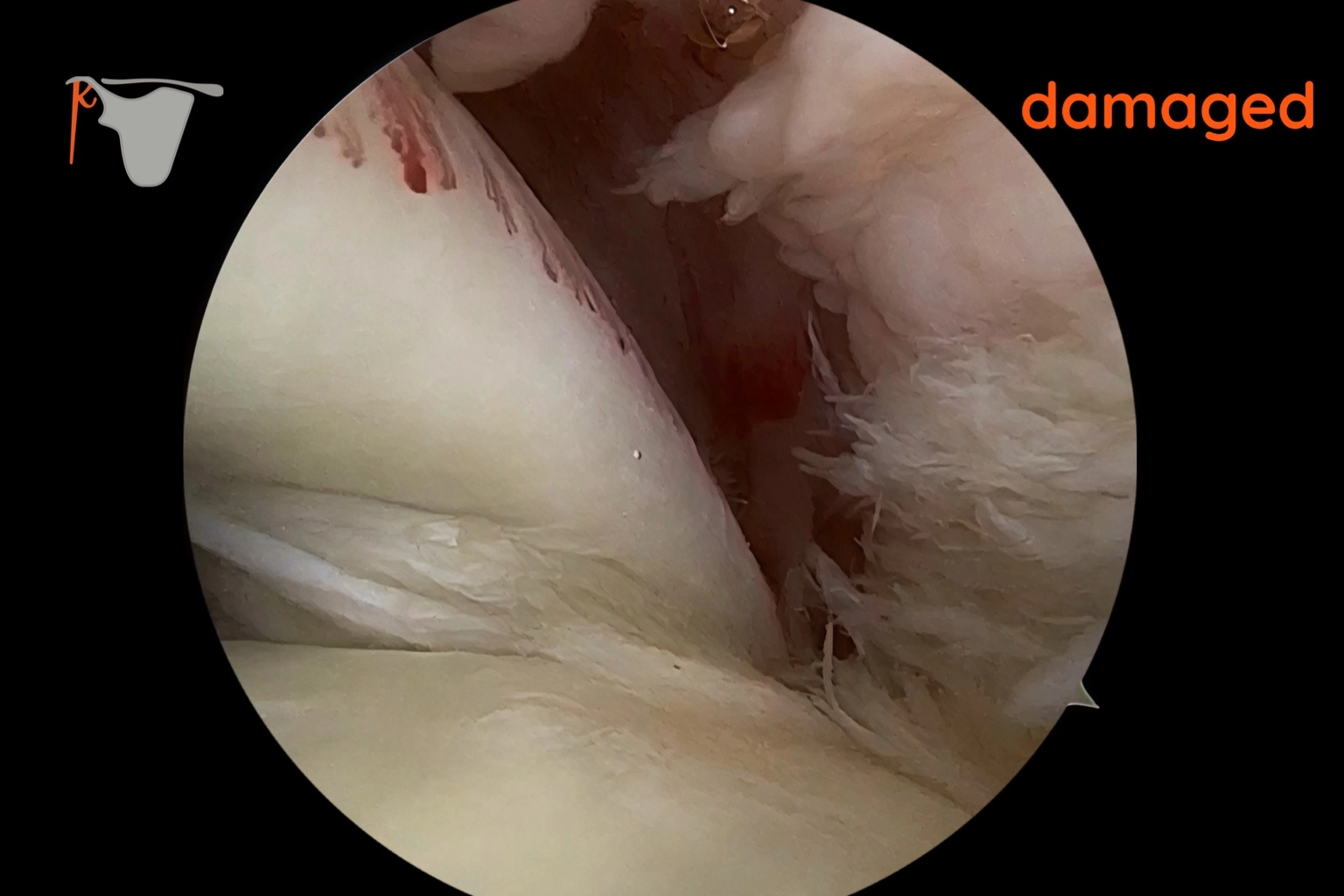 shoulder pain arthroscopy showing damaged shoulder joint in Dubai (Pulley-lesion)