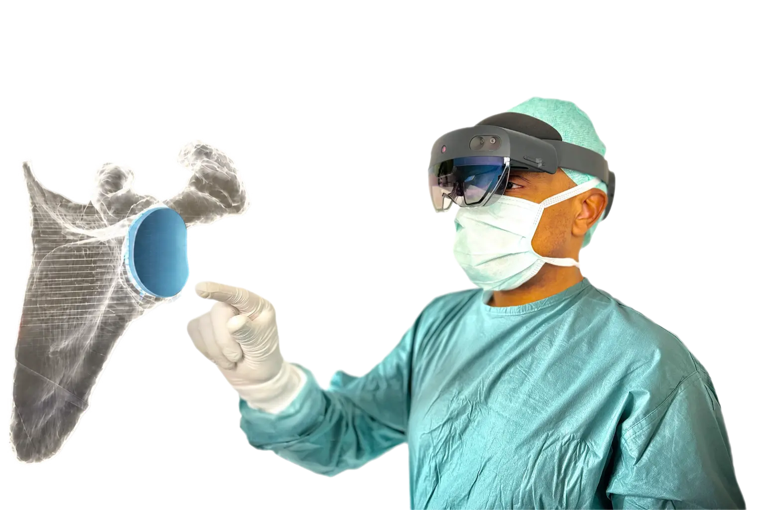3D planning for shoulder replacement in Dubai showing prosthesis positioning before surgery