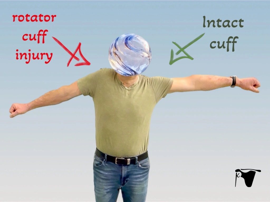 Patient demonstrating weakness and limited arm elevation caused by a rotator cuff tear compared with a healthy shoulder.