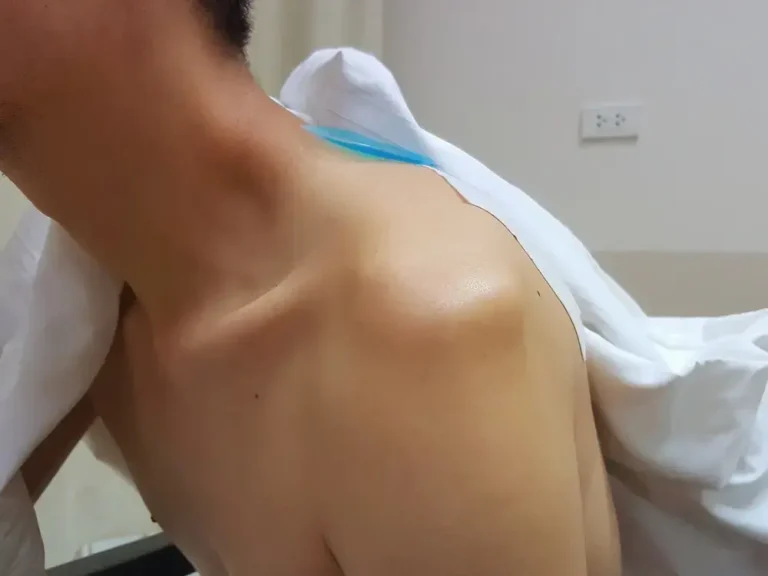 Real patient with shoulder dislocation demonstrating shoulder instability in Dubai
